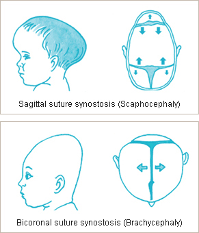 Types of craniosynostosis